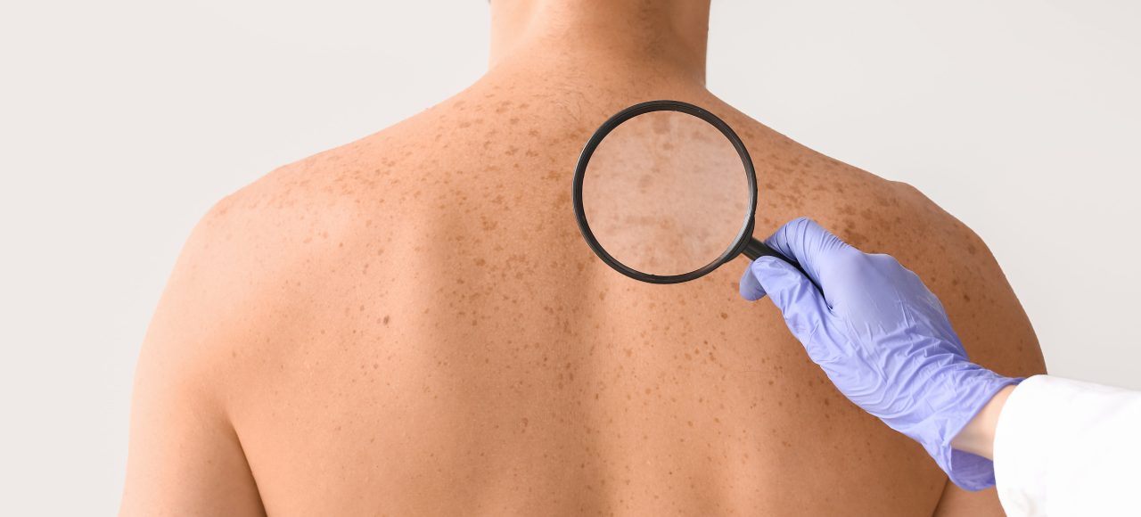 Białe plamy na skórze – skąd się biorą, co oznaczają