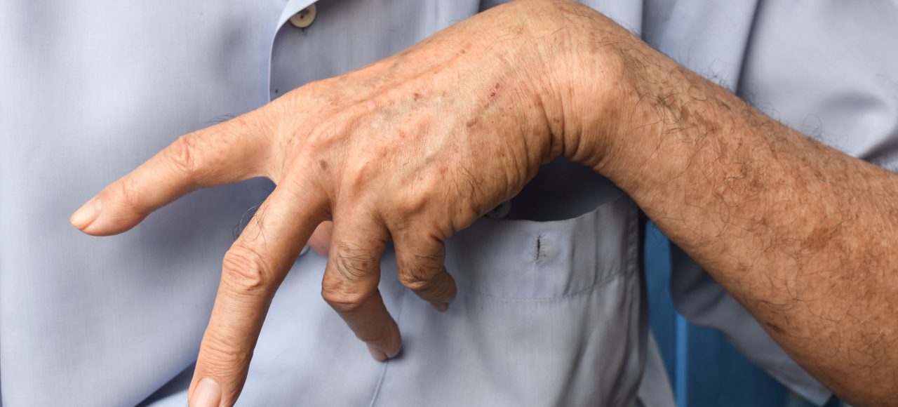 Przykurcz Dupuytrena, choroba Dupuytrena Katowice Globiana