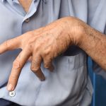 Przykurcz Dupuytrena, choroba Dupuytrena Katowice Globiana-min Przykurcz Dupuytrena, choroba Dupuytrena Katowice Globiana