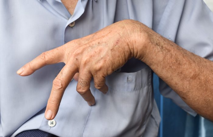 Przykurcz Dupuytrena, choroba Dupuytrena Katowice Globiana