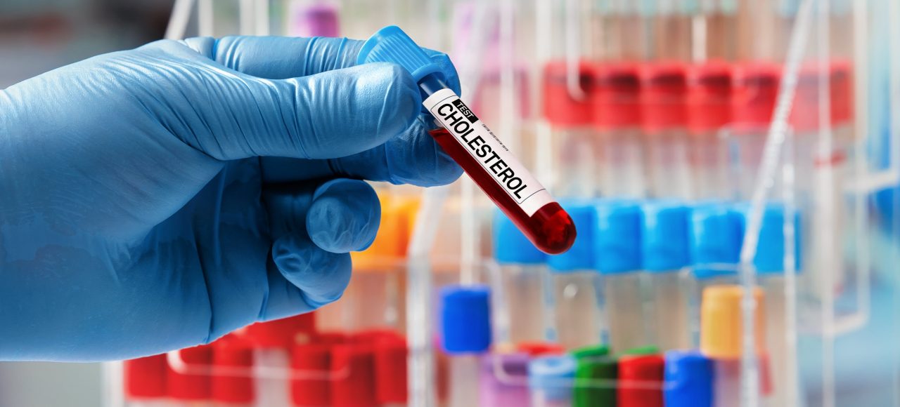 Z czego wynika podwyższony cholesterol